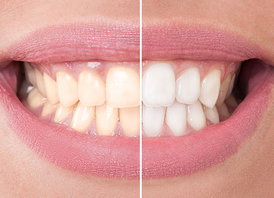 Teeth Whitening - Wisdom Dental