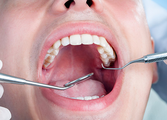 Amalgam to Composite - Wisdom Dental