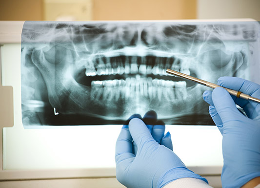 Root Canal - Wisdom Dental